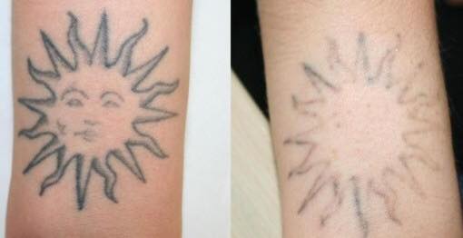 Zapraszamy na usuwanie tatuażu i źle zrobionego makijażu permanentnego.